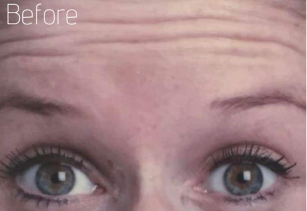 Forehead lines before anti wrinkle injections