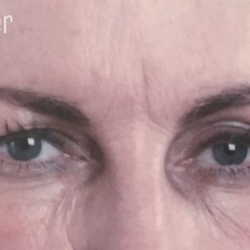 Frown lines After anti wrinkle injections