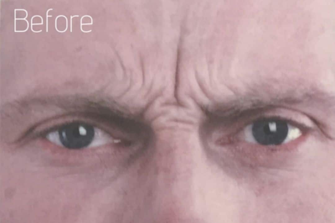Frown lines before anti wrinkle injections