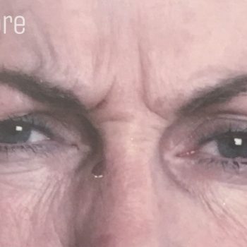 Frown lines before anti wrinkle injections.