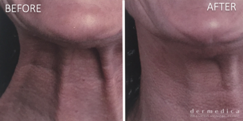 Before and After Anti Wrinkle Injections or Wrinkle Relaxers Treatment in Neck at Dermedica Perth