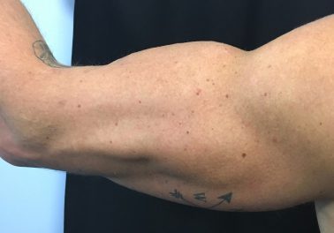 Arms After trusculpt id