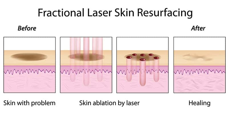 Derma Glow Fractional laser skin resurfacing