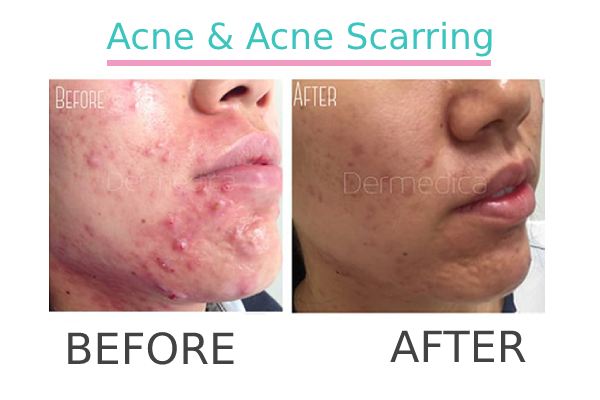 Acne and Scarring treatment to a patient before and after.