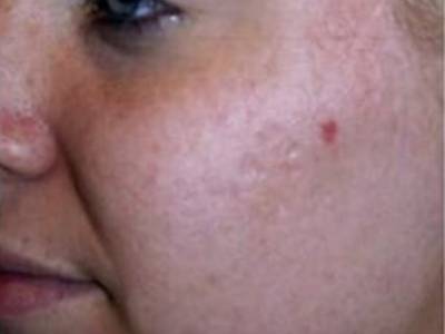 Acne scars treatment with Fractional resurfacing in Pearth after.