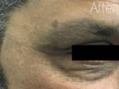 Crows feet of a mature man after wrinkle relaxer treatment