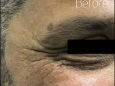 Crows feet of a mature man before anti wrinkle relaxer treatment