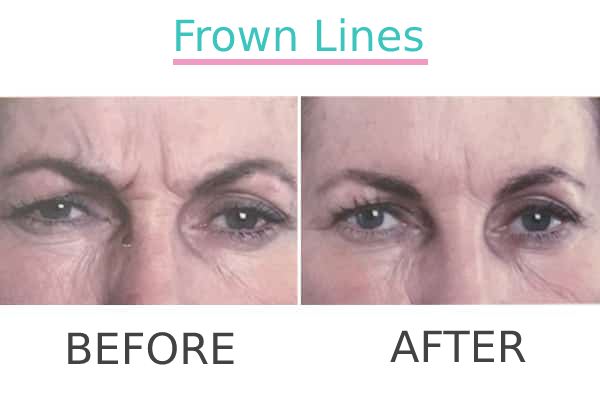 Close-up before and after view of a patient after forehead anti-wrinkle injections.