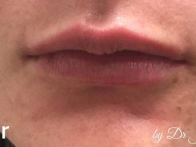 Lip filler treatment of a woman in Perth after.