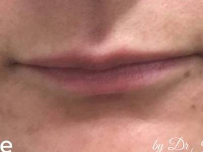 Lip filler of a woman in Perth before.