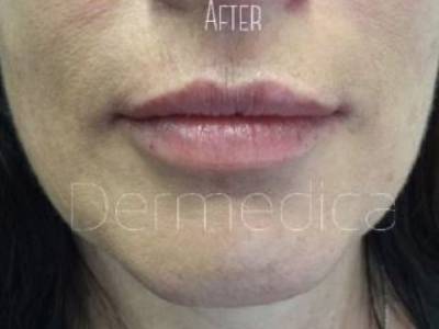 Lip filler procedure of a woman in Perth after.