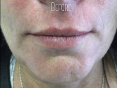 Lip filler procedure of a woman in Perth before.