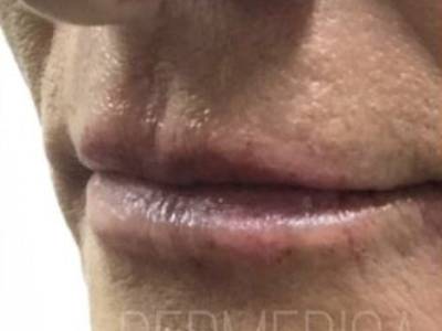 Lip filler treatment of a mature man after.