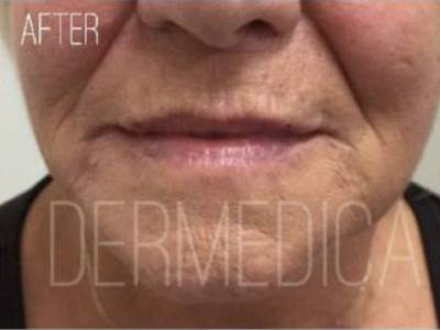 Lip filler treatment of a mature woman in Perth after.