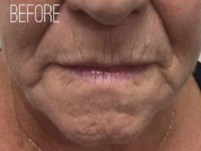 Lip filler treatment of a mature woman in Perth before.
