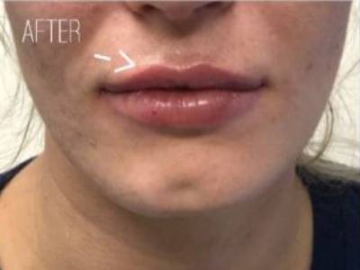 Lip filler treatment of a woman after in Perth.