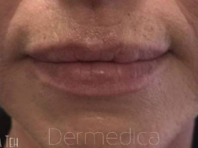 Lip filler treatment to a mature man in Perth after.