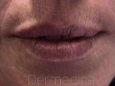 Lip filler treatment to a mature man in Perth before.