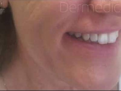 Non-surgical dermal filler of a woman in Perth after. 