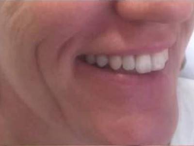 Non-surgical dermal filler of a woman in Perth.