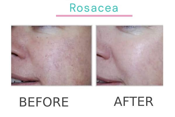 Rosacea treatment to a patient in Perth before and after.