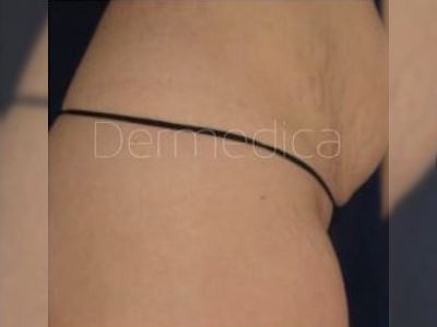 Nonsurgical Stretch Mark treatment of a patient in Perth after.