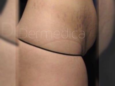 Nonsurgical Stretch Mark treatment of a patient in Perth before.