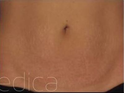 Nonsurgical Stretch Mark treatment of a patient in Perth after.
