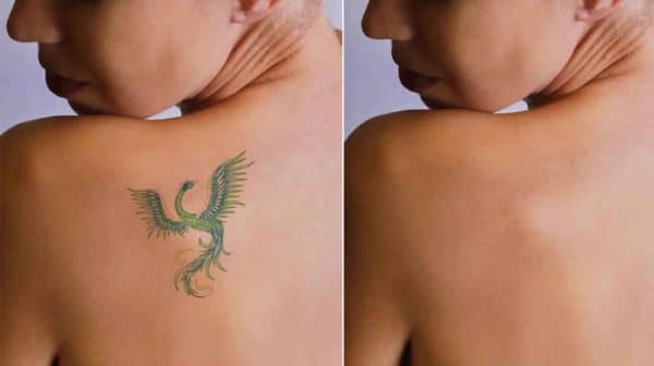 Laser Tattoo Removal in Valencia, CA | Infinity Med Spa