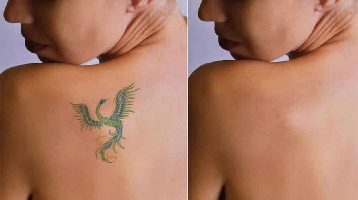 Tattoo removal treatment at Dermedica