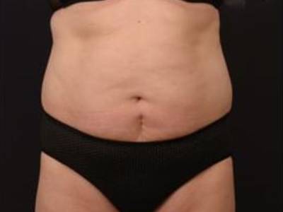 Non surgical liposuction method for patients in Perth after.