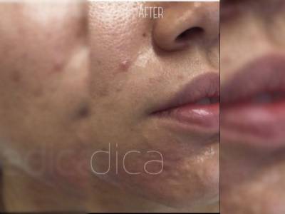 Severe acne of a patient in Perth after treatment.