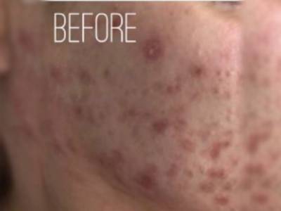 Severe acne of a patient in Perth before treatment.