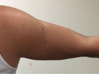 Coolscupting Arm fat removal with after in Perth.