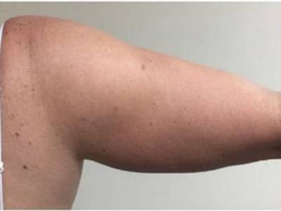 Coolscupting Arm fat removal with before in Perth.