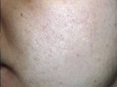 Fractional resurfacing in acne cheeks in Perth after.