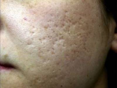 Fractional resurfacing in acne cheeks in Perth before.