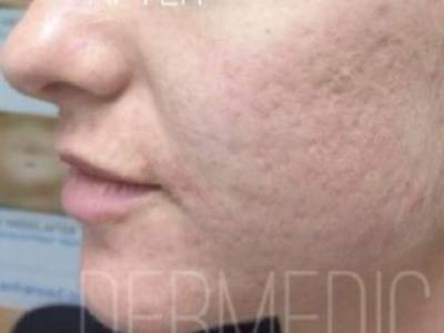 Cheeks acne scars after fractional resurfacing treatment in perth.