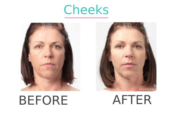 Before and after result of non surgical facelift in cheeks.