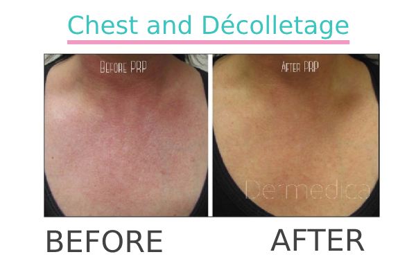 Chest and decolletage lines treatment to a patient before and after.