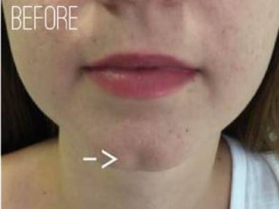 chin of a woman before chin filler treatment