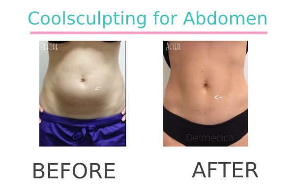 Coolsculpting tummy fat of a patient in Perth before and after.