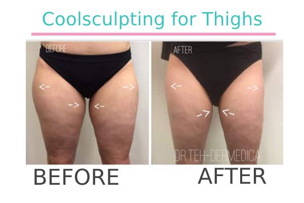 Coolsculpting thigh fat of a patient in Perth before and after.