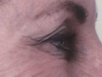 crow's feet of a adult woman after antiwrinkle relaxer