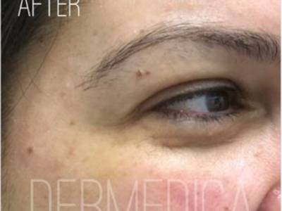 crows feet of a woman after anti wrinkle injection