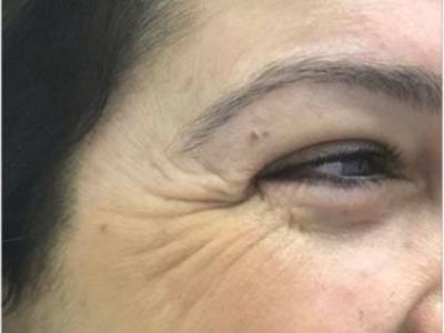 crows feet of a woman before anti wrinkle injection