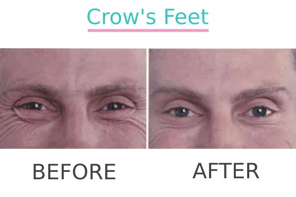 Close-up results of effective anti-wrinkle injections for crow's feet of a man.