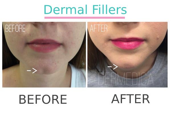 Dermal Filler effective result before and after.