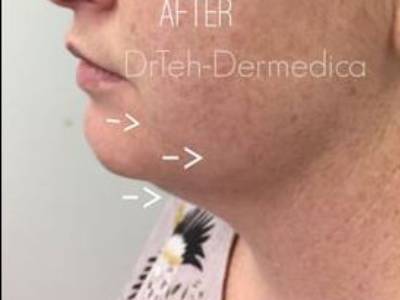 Double chin of a patient in Perth after treatment.
