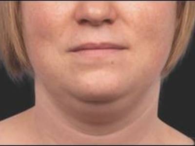 Double chin of a patient in Perth before treatment.